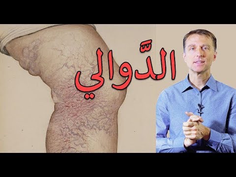 علاج الدوالي السطحيه ومعرفه سببها