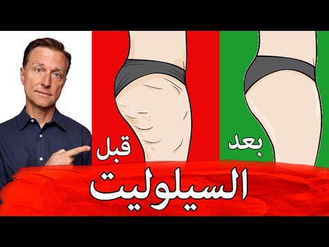 السبب الحقيقي للسيلوليت وطريقه للتخلص منه