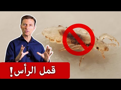 التخلص من لقمل الرأس في المنزل 0 204