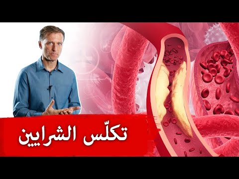 القضاء على تكلس الشرايين 0 113