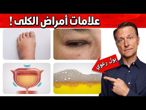 علامات معينه لامراض الكلى وافضل طعام للوقايه منه