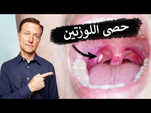 علامات لا يجب اهمالها لحصى اللوزتين 0 190