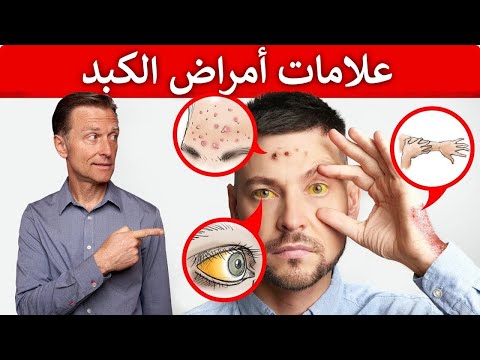 علامات تظهر في الجلد تدل على امراض الكبد 0 139