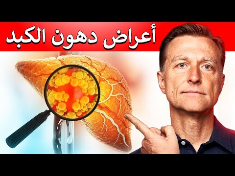 ما هي اعراض دهون الكبد 0 158