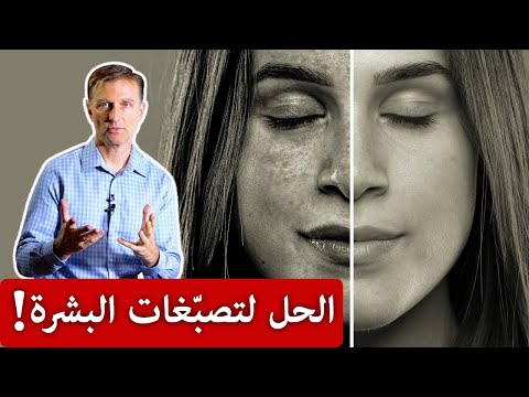 القضاء على تصبغات الوجه 0 2