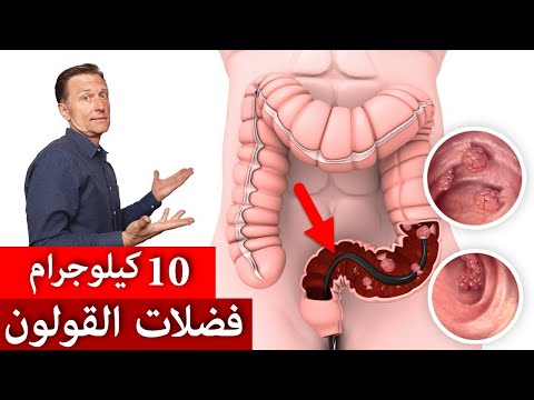 هل لدينا حقًا ما يعادل 10 كيلوجرام من الفضلات السامة في القولون؟ | تنظيف وتطهير القولون