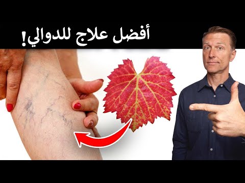 علاج طبيعي للتخلص من الدوالي