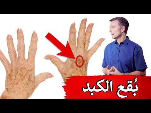 اسباب وعلاج البقع الجلديه وعلاقتها بالكبد