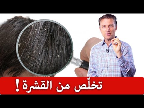 الحل النهائي للقضاء على القشره طبيعياّ 0 138