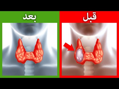 التخلص من اورام الغده الدرقيه طبيعياّ