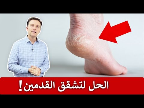 القضاء على جفاف وتشققات القدمين 0 28