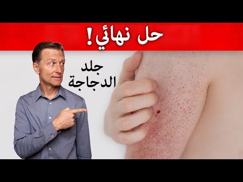 القضاء على جلد الوزه بالطريقه الطبيعيه