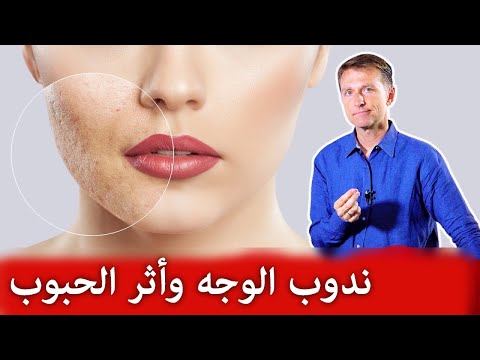 زيت فعال للتخلص من ندوب الجلد واثار حب الشباب