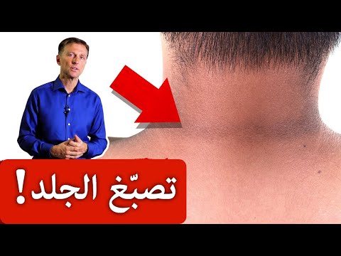 الحل النهائي لتصبغات الجلد الموجوده في الرقبه 0 183