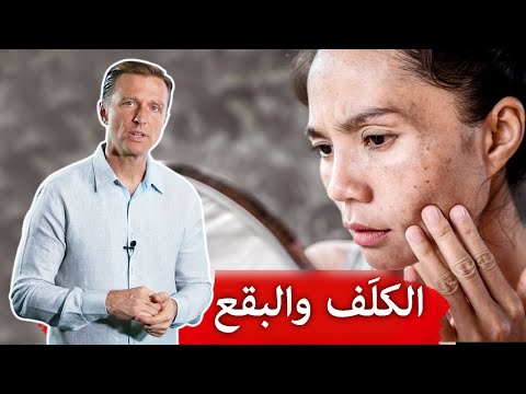 اسباب الكلف والبقع الموجوده في الجلد 0 33